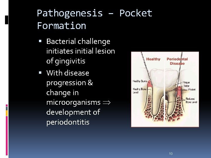 Pathogenesis – Pocket Formation Bacterial challenge initiates initial lesion of gingivitis With disease progression