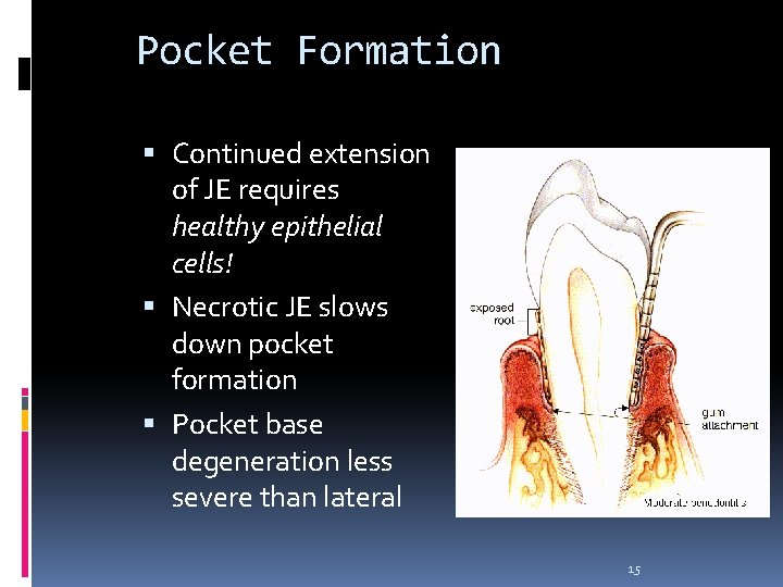 Pocket Formation Continued extension of JE requires healthy epithelial cells! Necrotic JE slows down