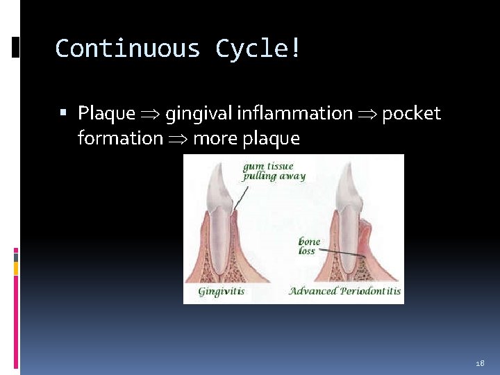 Continuous Cycle! Plaque gingival inflammation pocket formation more plaque 18 