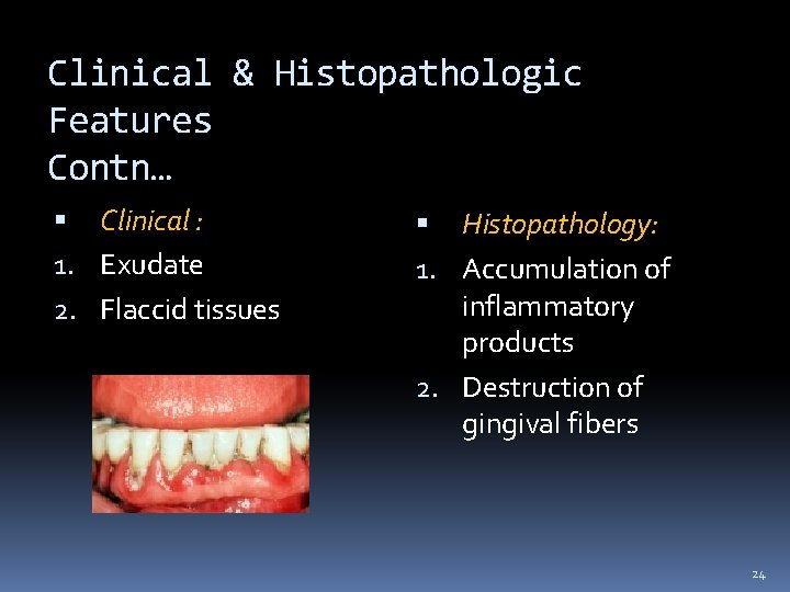 Clinical & Histopathologic Features Contn… Clinical : 1. Exudate 2. Flaccid tissues Histopathology: 1.