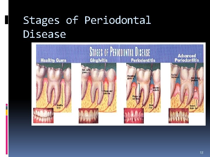 Stages of Periodontal Disease 25 