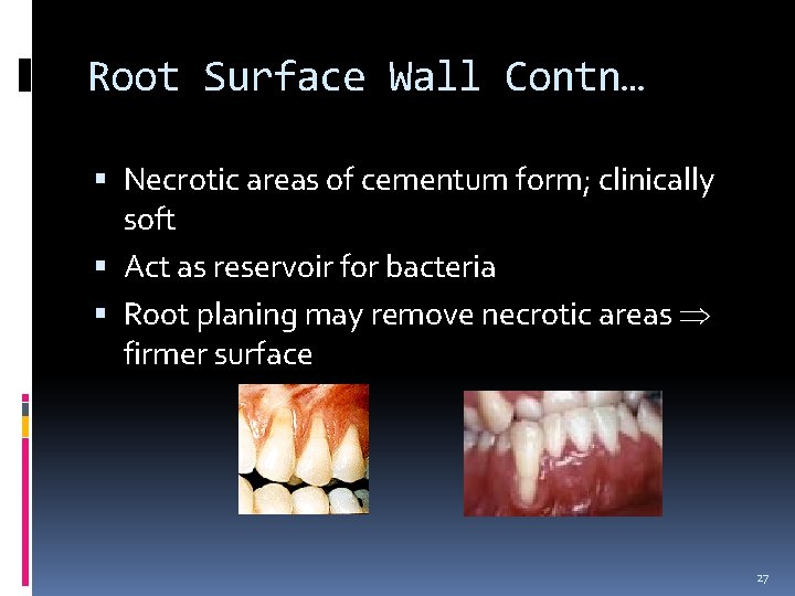 Root Surface Wall Contn… Necrotic areas of cementum form; clinically soft Act as reservoir