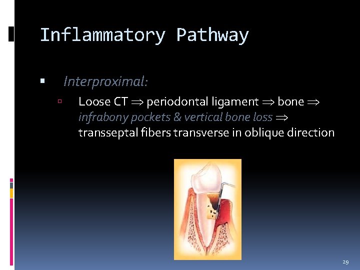 Inflammatory Pathway Interproximal: Loose CT periodontal ligament bone infrabony pockets & vertical bone loss