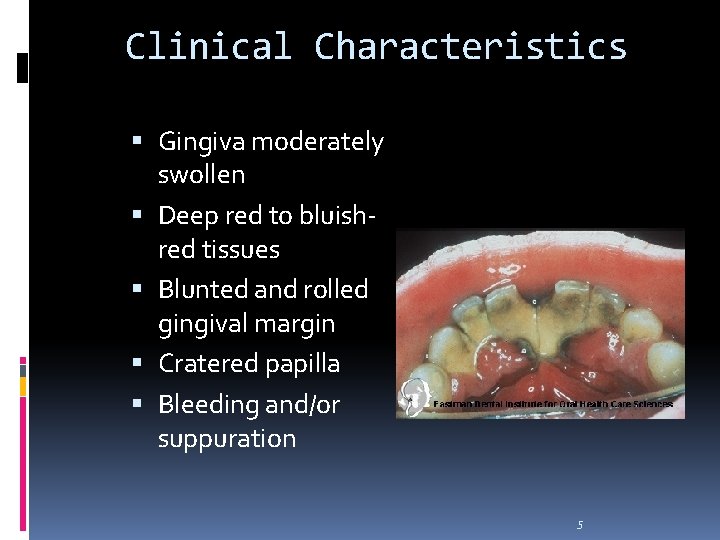 Clinical Characteristics Gingiva moderately swollen Deep red to bluishred tissues Blunted and rolled gingival