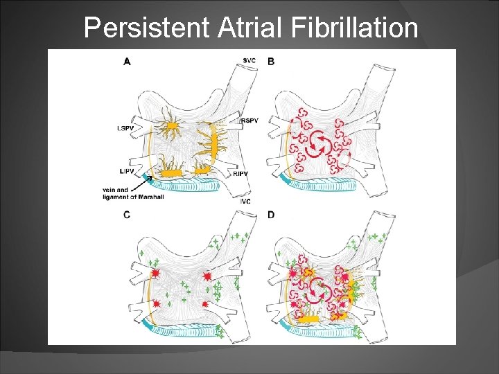 Persistent Atrial Fibrillation 