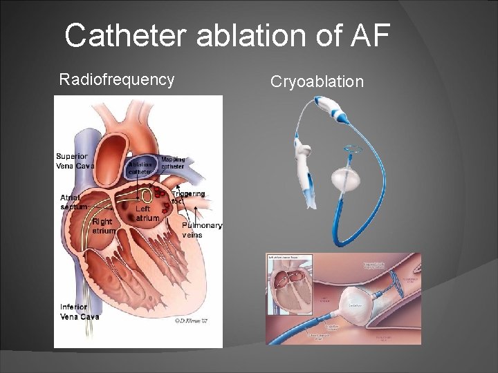 Catheter ablation of AF Radiofrequency Cryoablation 