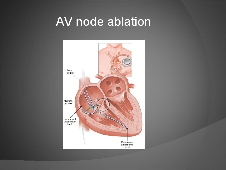 AV node ablation 