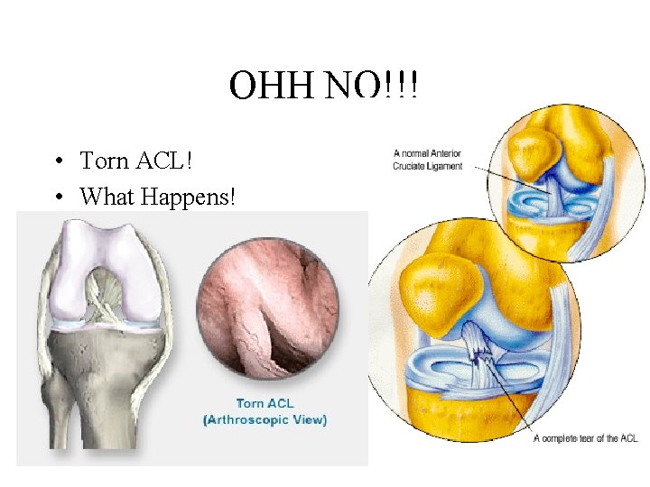 OHH NO!!! • Torn ACL! • What Happens! 