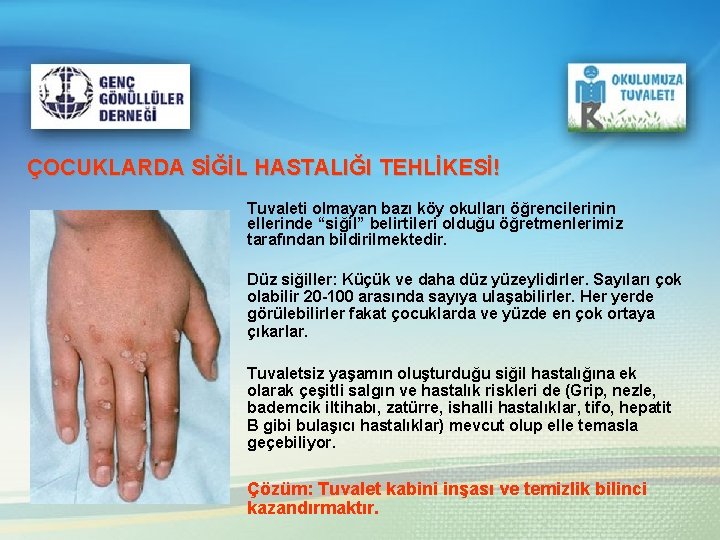 ÇOCUKLARDA SİĞİL HASTALIĞI TEHLİKESİ! Tuvaleti olmayan bazı köy okulları öğrencilerinin ellerinde “siğil” belirtileri olduğu