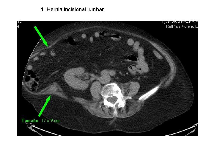 1. Hernia incisional lumbar Tamaño: 17 x 9 cm 