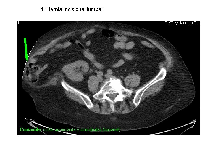 1. Hernia incisional lumbar Contenido: colón ascendente y asas ileales (visceral) 