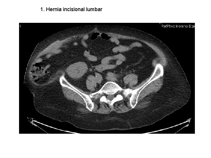 1. Hernia incisional lumbar 
