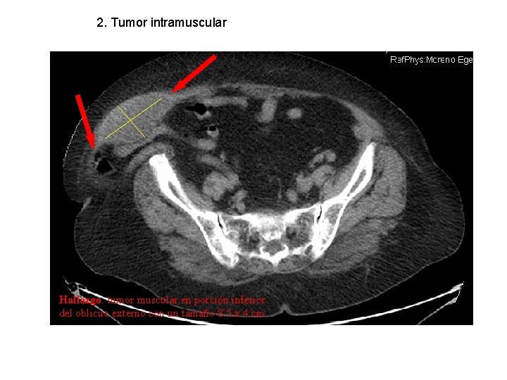 2. Tumor intramuscular Hallazgo: tumor muscular en porción inferior del oblicuo externo con un