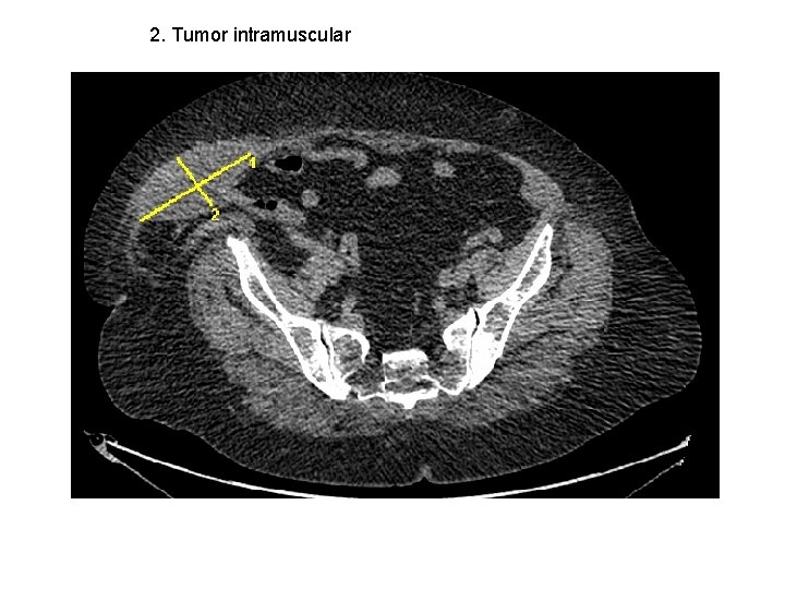 2. Tumor intramuscular 