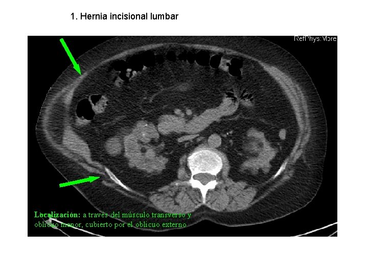 1. Hernia incisional lumbar Localización: a través del músculo transverso y oblicuo menor, cubierto