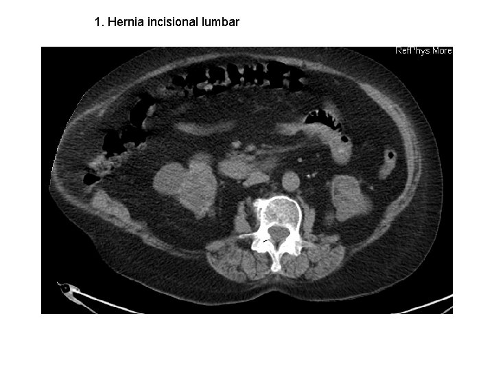 1. Hernia incisional lumbar 