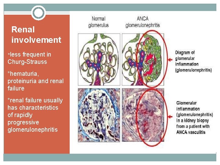 Renal involvement *less frequent in Churg-Strauss *hematuria, proteinuria and renal failure *renal failure usually