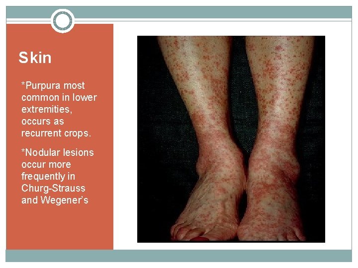 Skin *Purpura most common in lower extremities, occurs as recurrent crops. *Nodular lesions occur