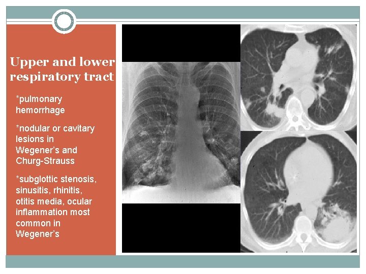 Upper and lower respiratory tract *pulmonary hemorrhage *nodular or cavitary lesions in Wegener’s and