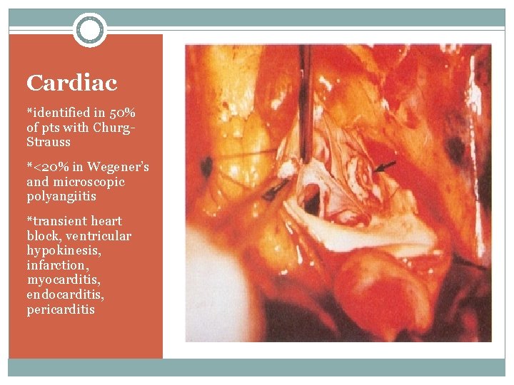 Cardiac *identified in 50% of pts with Churg. Strauss *<20% in Wegener’s and microscopic