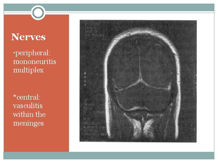 Nerves *peripheral: mononeuritis multiplex *central: vasculitis within the meninges 