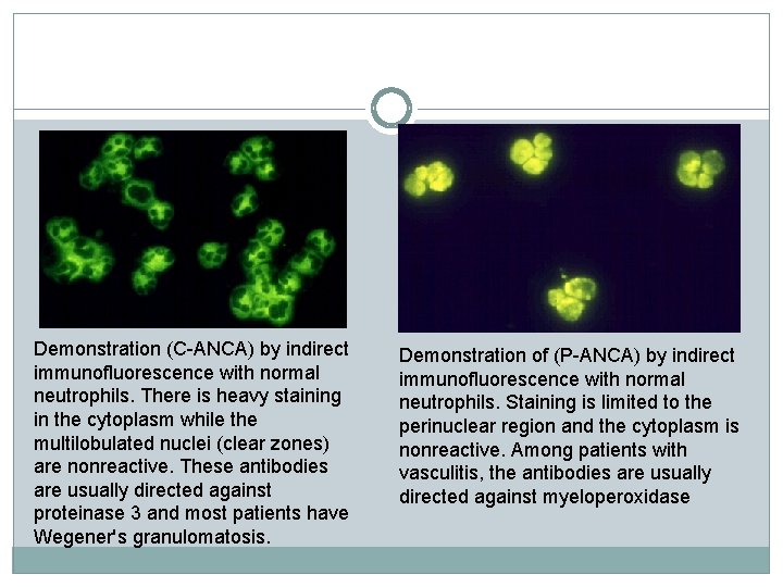 Demonstration (C-ANCA) by indirect immunofluorescence with normal neutrophils. There is heavy staining in the