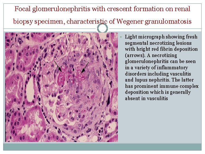 Focal glomerulonephritis with crescent formation on renal biopsy specimen, characteristic of Wegener granulomatosis •