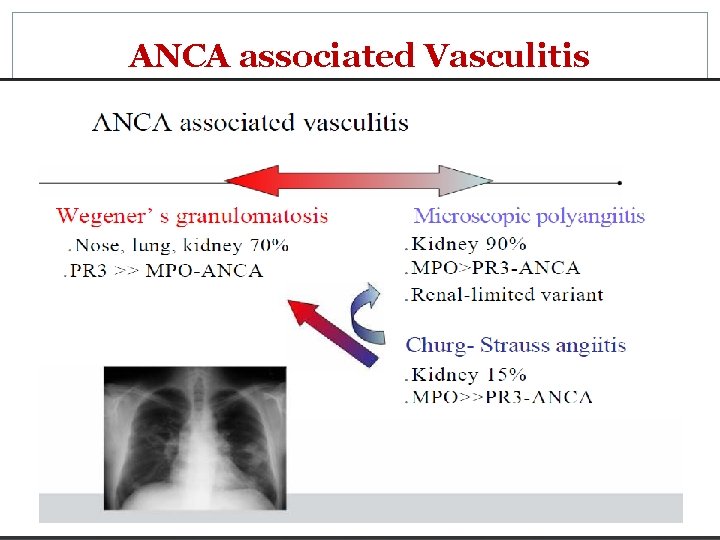 ANCA associated Vasculitis 
