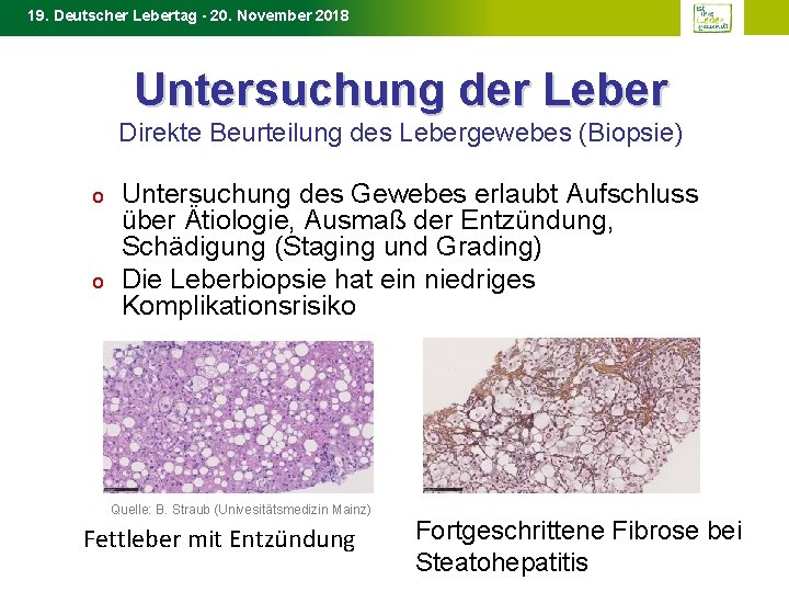 19. Deutscher Lebertag - 20. November 2018 Untersuchung der Leber Direkte Beurteilung des Lebergewebes