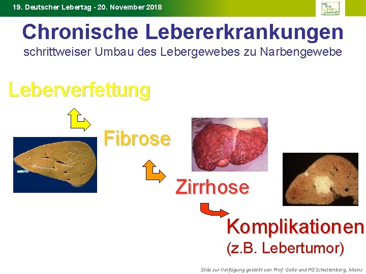 19. Deutscher Lebertag - 20. November 2018 Chronische Lebererkrankungen schrittweiser Umbau des Lebergewebes zu