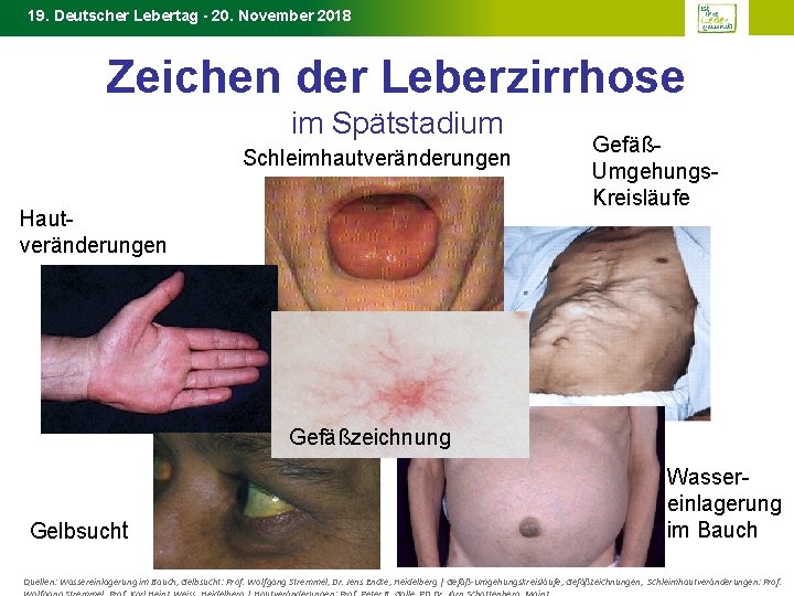19. Deutscher Lebertag - 20. November 2018 Zeichen der Leberzirrhose im Spätstadium Schleimhautveränderungen Hautveränderungen