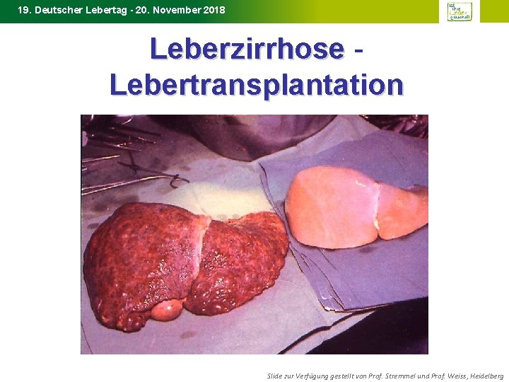 19. Deutscher Lebertag - 20. November 2018 Leberzirrhose - Leberzirrhose Lebertransplantation Slide zur Verfügung