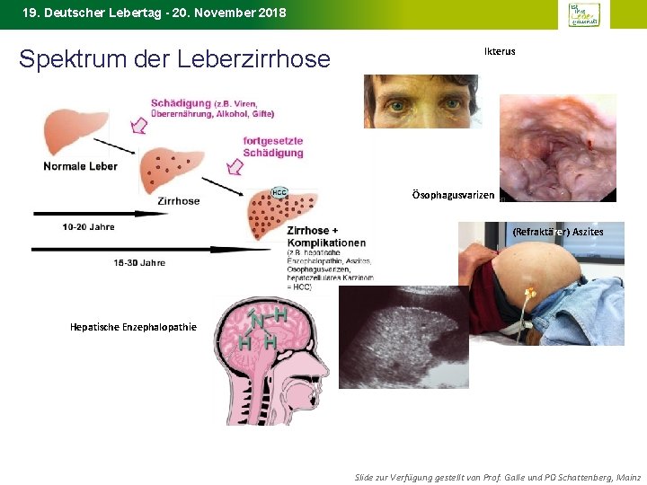 19. Deutscher Lebertag - 20. November 2018 Spektrum der Leberzirrhose Ikterus Ösophagusvarizen (Refraktärer) Aszites