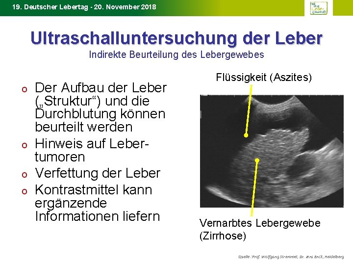 19. Deutscher Lebertag - 20. November 2018 Ultraschalluntersuchung der Leber Indirekte Beurteilung des Lebergewebes