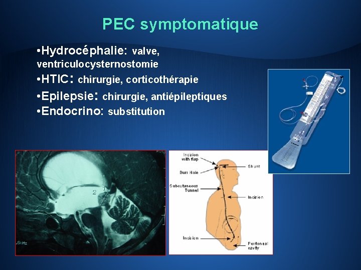 PEC symptomatique • Hydrocéphalie: valve, ventriculocysternostomie • HTIC: chirurgie, corticothérapie • Epilepsie: chirurgie, antiépileptiques