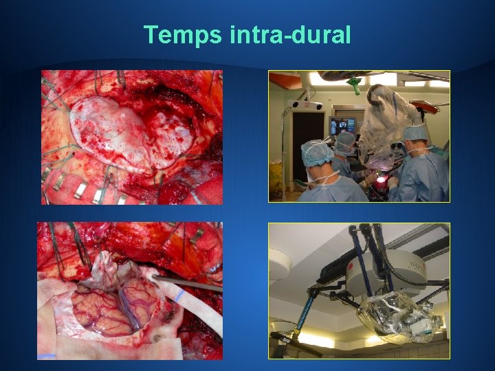 Temps intra-dural 