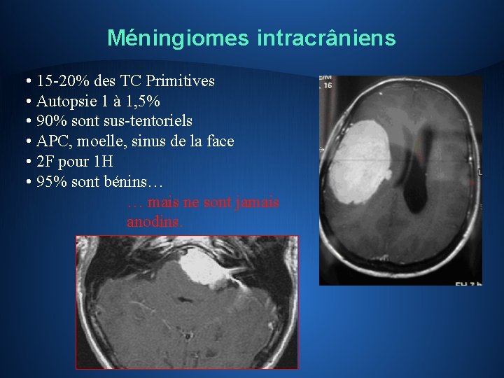 Méningiomes intracrâniens • 15 -20% des TC Primitives • Autopsie 1 à 1, 5%