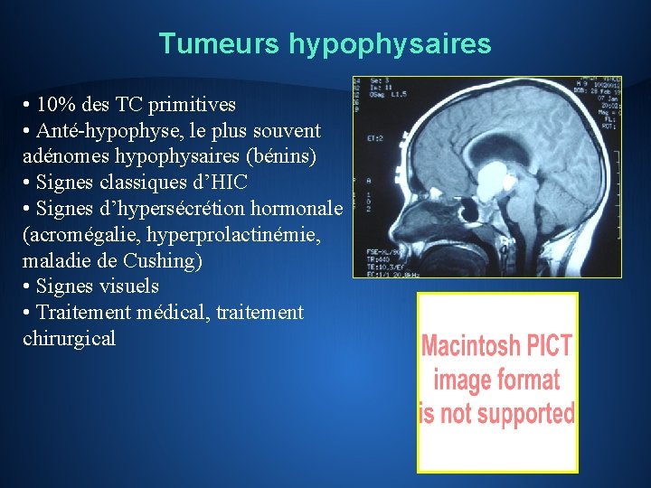 Tumeurs hypophysaires • 10% des TC primitives • Anté-hypophyse, le plus souvent adénomes hypophysaires