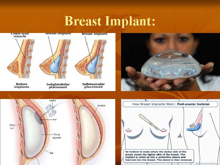 Breast Implant: 