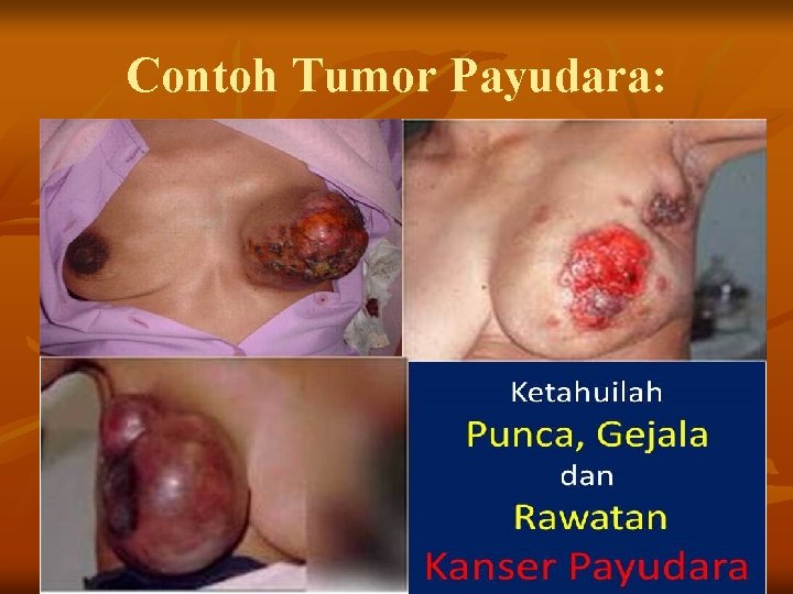 Contoh Tumor Payudara: 