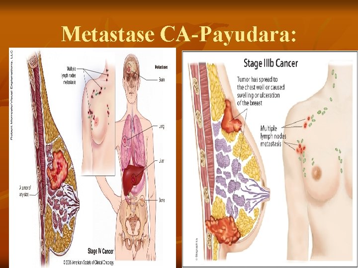 Metastase CA-Payudara: 