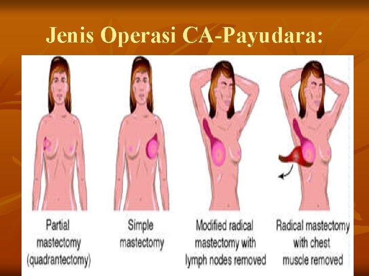 Jenis Operasi CA-Payudara: 