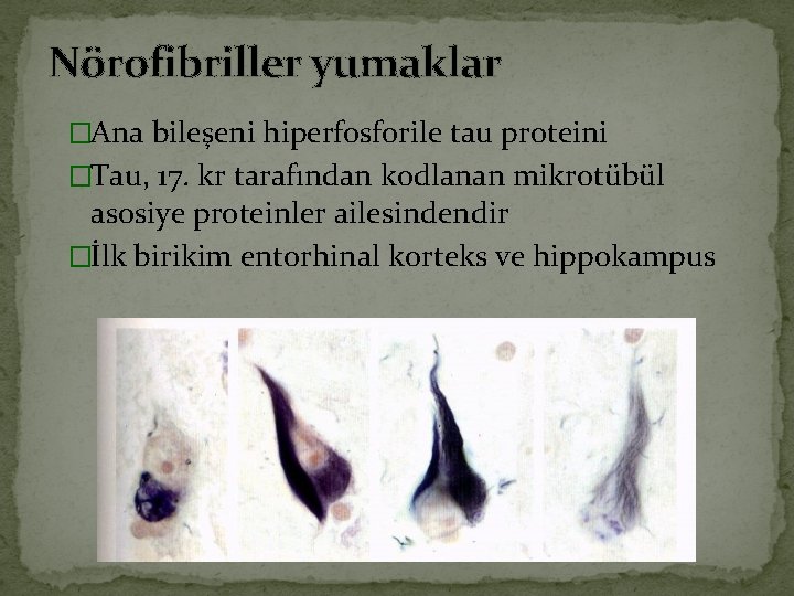 Nörofibriller yumaklar �Ana bileşeni hiperfosforile tau proteini �Tau, 17. kr tarafından kodlanan mikrotübül asosiye