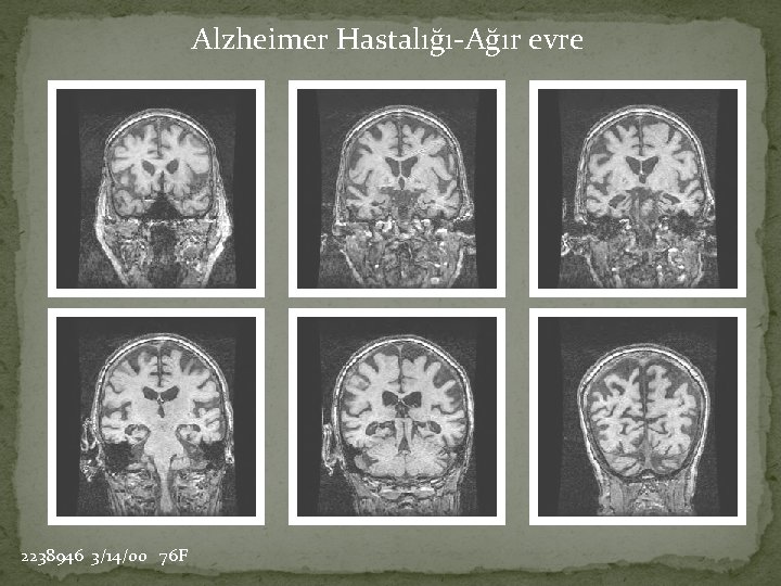 Alzheimer Hastalığı-Ağır evre 2238946 3/14/00 76 F 