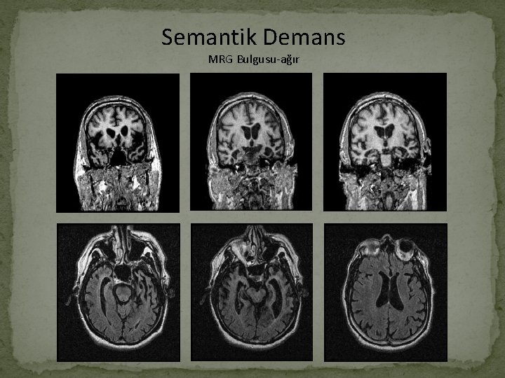 Semantik Demans MRG Bulgusu-ağır 