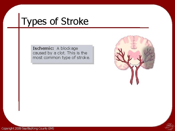 Types of Stroke Ischemic: A blockage caused by a clot. This is the most