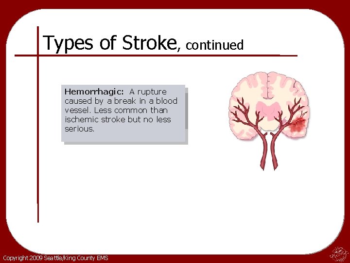 Types of Stroke, continued Hemorrhagic: A rupture Ischemic: A blockage caused by a break