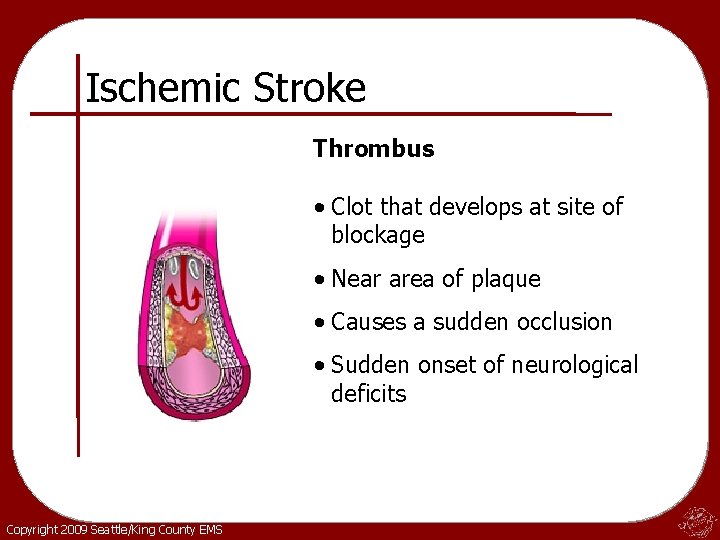 Ischemic Stroke Thrombus • Clot that develops at site of blockage • Near area Ischemic Stroke Thrombus • Clot that develops at site of blockage • Near area