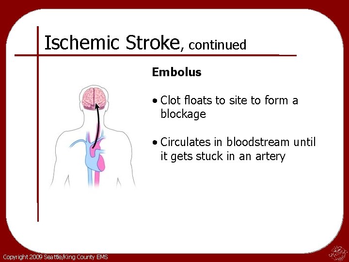 Ischemic Stroke, continued Embolus • Clot floats to site to form a blockage •