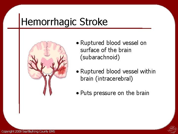 Hemorrhagic Stroke • Ruptured blood vessel on surface of the brain (subarachnoid) • Ruptured